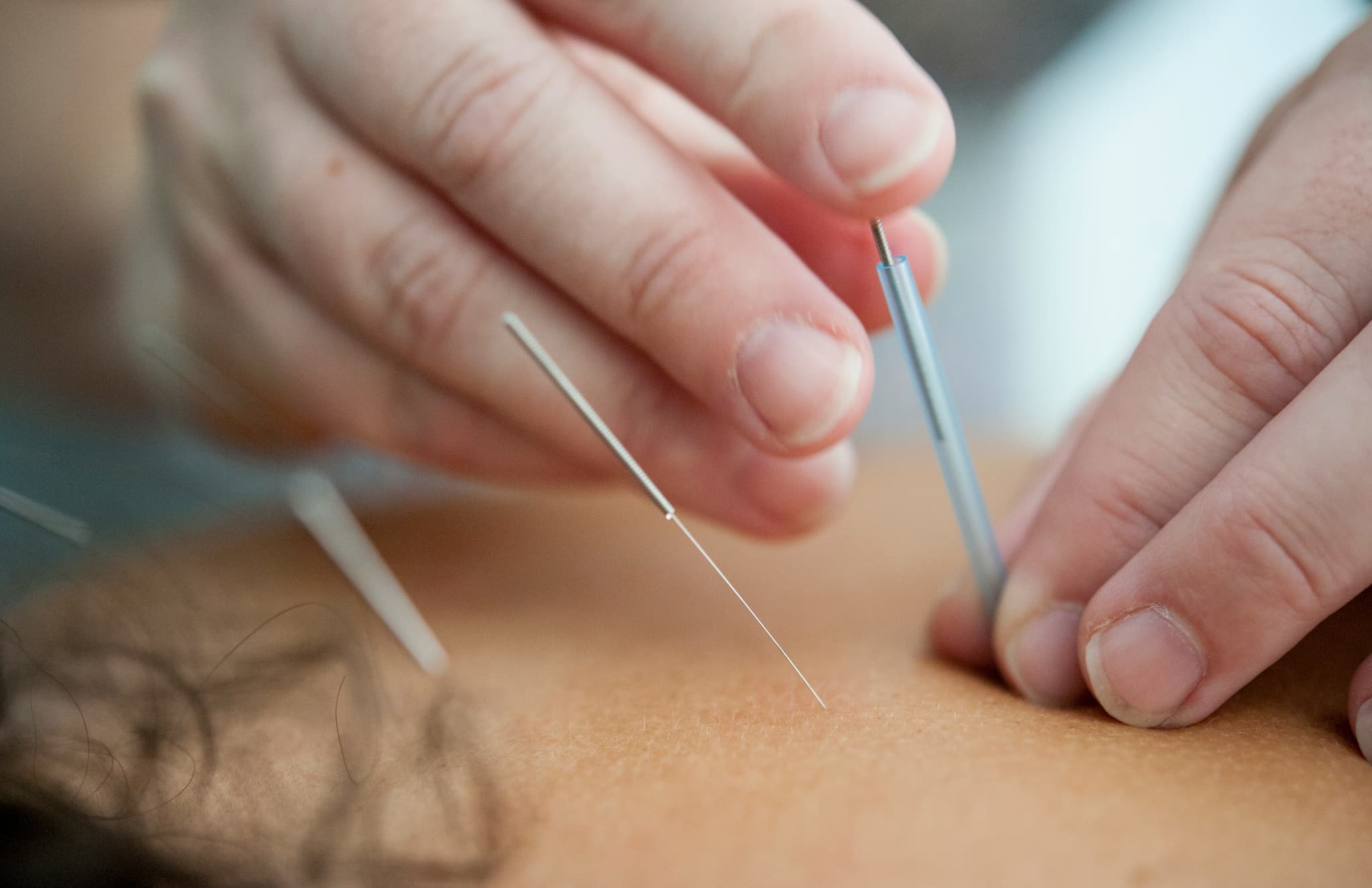 Acupuncture Needle Treatment Hands performing an acupuncture treatment, with thin needles being inserted into the skin.