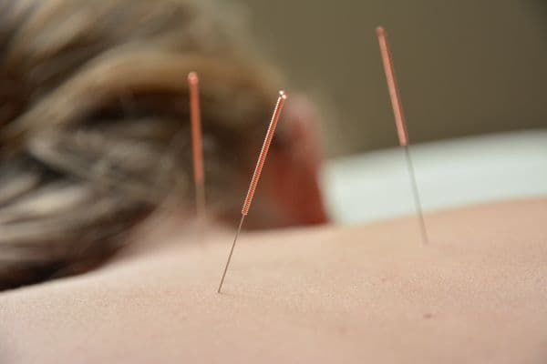 Acupuncture Needles Treatment Acupuncture needles inserted into skin during treatment session.
