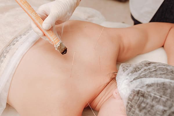 Acupuncture Treatment on Back Acupuncture practitioner inserting thin needles into a patient's back during a treatment session.